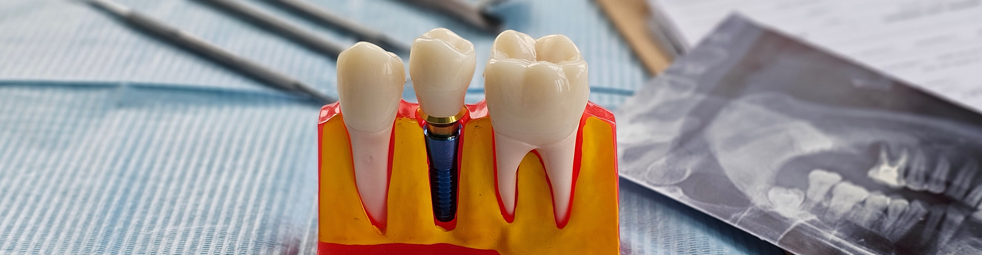 model of dental implant between two teeth